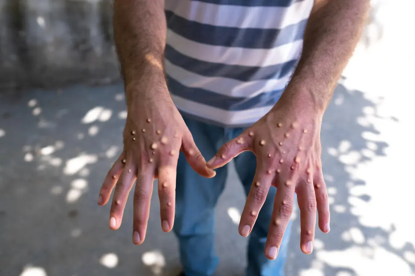 What You Need to Know about Mpox (Monkeypox)
